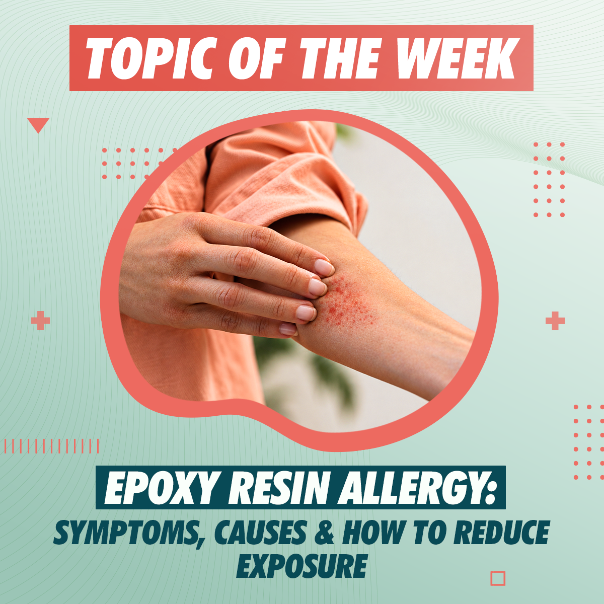 Can You Be Allergic to Epoxy Resin?
